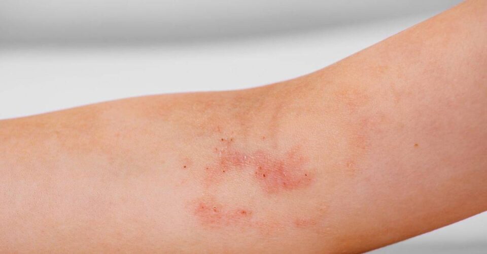 eczema Singapore